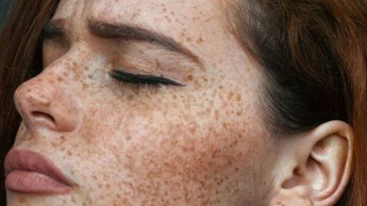 freckles-1024x538-1