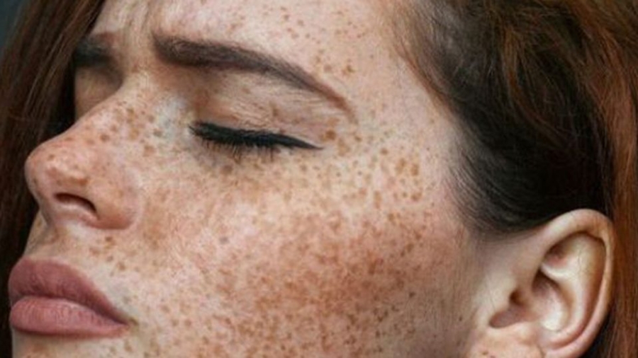 freckles-1024x538-1