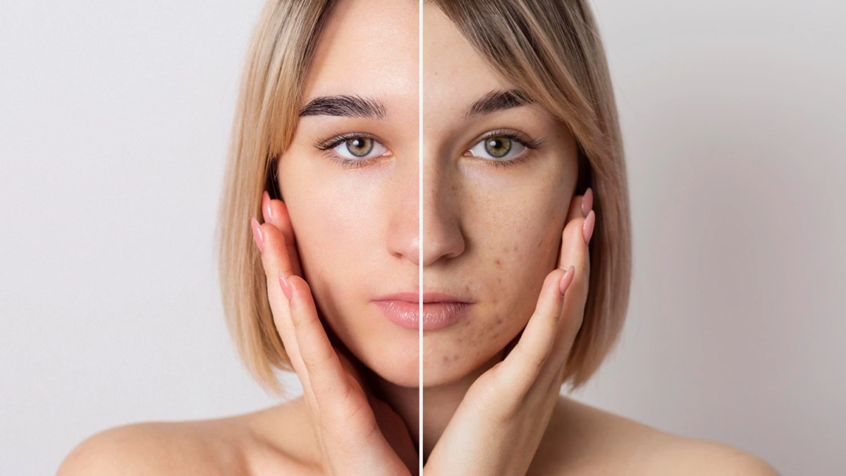melasma
