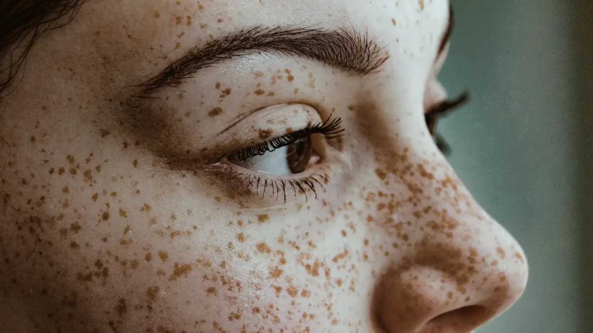 Freckles (1)