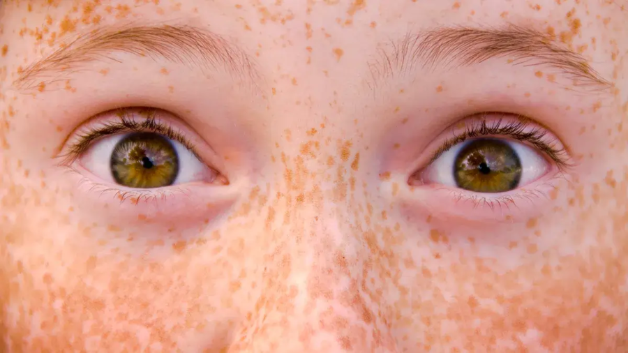 Freckles sd