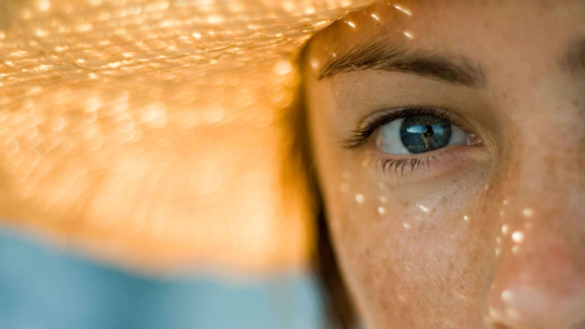 melasma