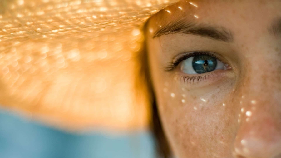 melasma